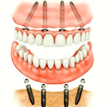 IMPIANTO ALL ON FOUR - PROTESI FISSA IN TITANIO dai DENTISTI in CROAZIA